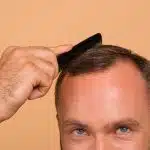 greffe de cheveux montpellier
