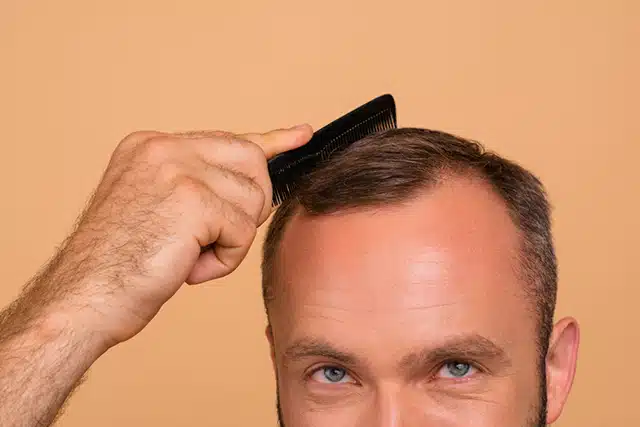 Le chemin vers un nouveau vous : l&rsquo;essor de la greffe de cheveux à Montpellier