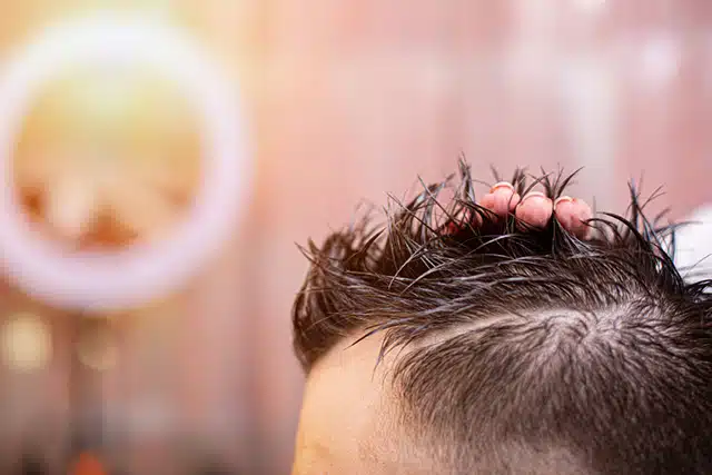 Révélations sur les greffes de cheveux des stars : transformations et confidences